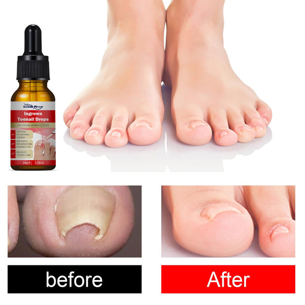 Ingrown Toenail Treatment Serum Nail Correction Recover Oil Pain Reliever Nail Softener Trim with Ease Oil Feet Health Care Safe